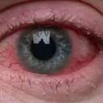 eye allergies